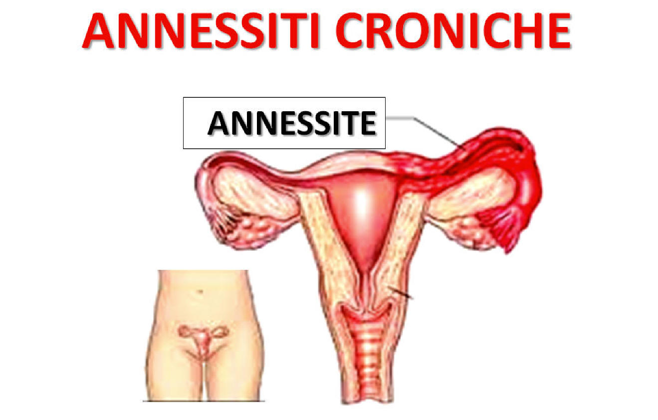 Annessite, cos'è? Rimedi naturali, ecografia, terapia antibiotica, sintomi